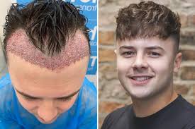 Factors Affecting Hair Transplant Turkey Price: What to Know